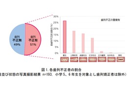 子供の歯並び、半数以上が歯列不正...口呼吸・姿勢が影響