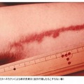 刺された時の写真