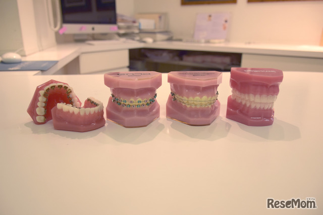 歯列矯正器具の種類