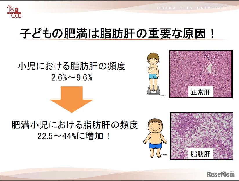 小児の肥満と脂肪肝の関係