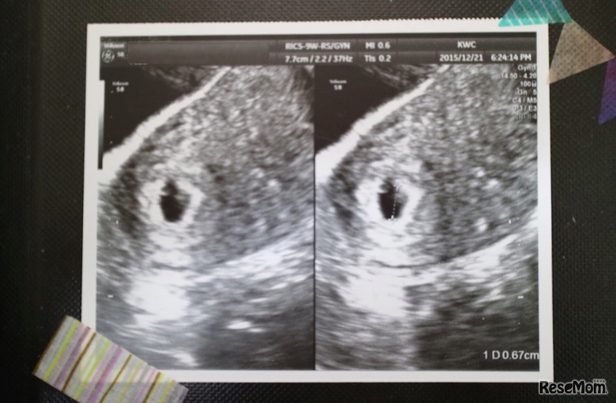 一番初めのエコー画像。1年ほど前はこんな状態だったとは