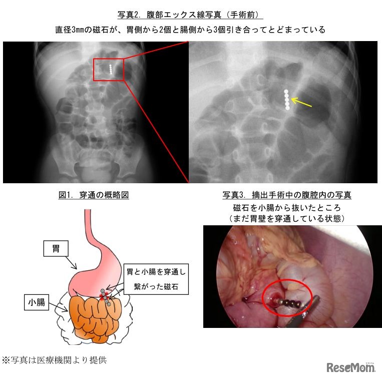 腹部エックス線写真（手術前）