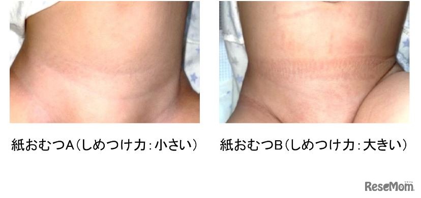 紙おむつの腹部へのしめつけによるゴム跡の違い（顕著な例）