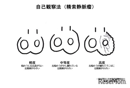 中学生からでもできる精索静脈瘤セルフチェック表