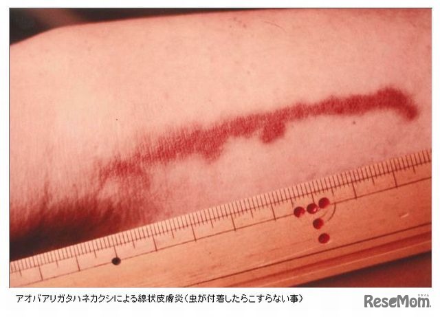 刺された時の写真