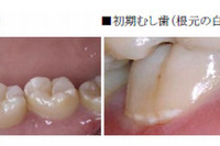 初期むし歯対策でむし歯予防を…子どものころからのケアが重要、江崎グリコ 画像