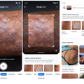 Googleレンズ、肌の状態を写真で「検索」可能に。表現が難しい症状も対応、医療機関への相談を推奨