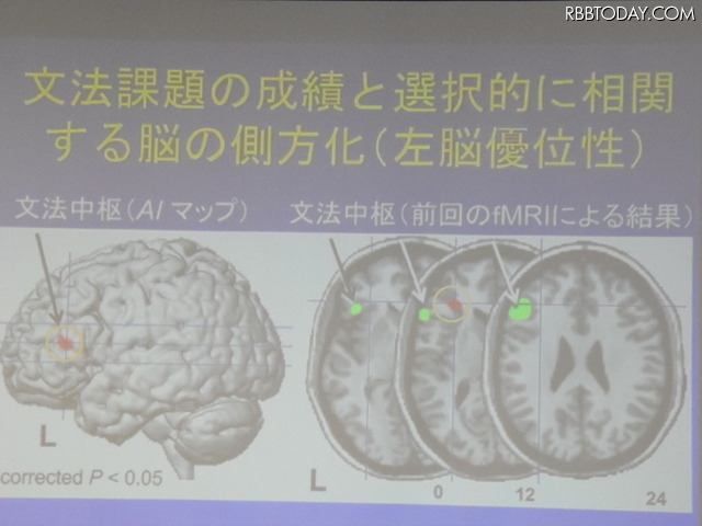 酒井氏の研究結果。言語を習得が得意な人は、文法中枢が非対称で、体積も大きく優位になることを突きとめた