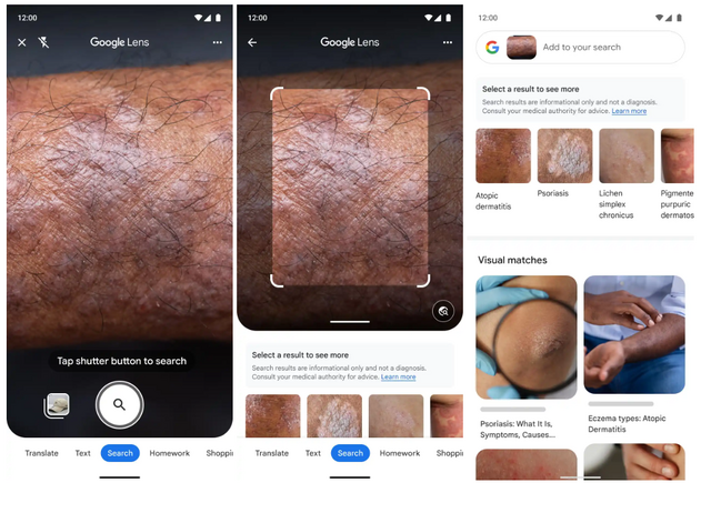 Googleレンズ、肌の状態を写真で「検索」可能に。表現が難しい症状も対応、医療機関への相談を推奨