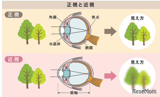 正視と近視